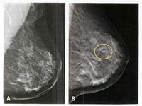 snimak tumora dojke